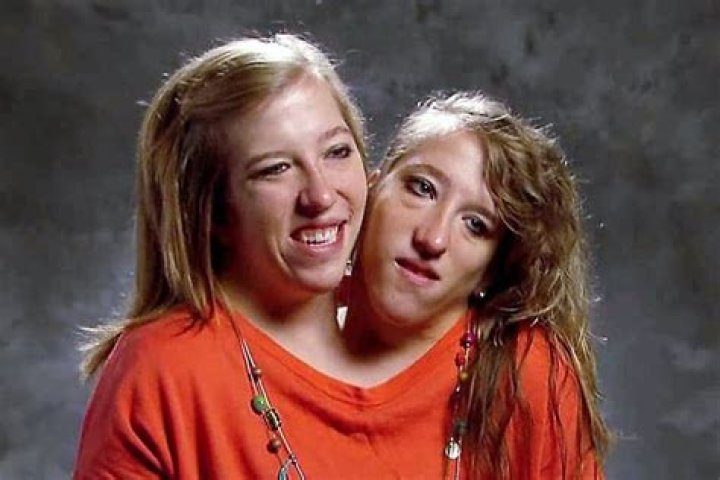 Abby and Brittany Hensel: The Remarkable Story of Conjoined Twins Living Life to the Fullest