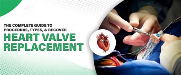 Mitral Valve Replacement Recovery: A Comprehensive Guide to a Successful Recovery Process